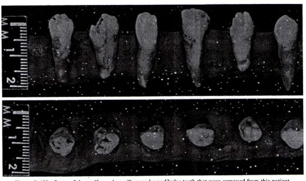 Gambar 5 Beberapa bentuk dari kelainan gigi yang sudah dikeluarkan dari pasien Kleidokranial displasia.( Archer
