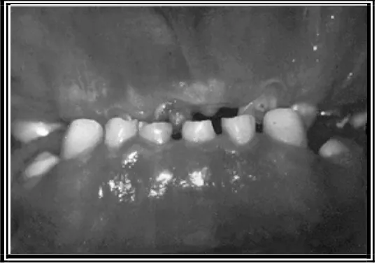 Gambar 6 Pandangan fasial kondisi gigi geligi Dirienzo. S,Serman. N. penderita Kleidokranial displasia usia 12 tahun memperlihatkan persistensi gigi desidui.( Silva