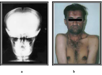 Gambar 8  acase report. daerah supraglabellar pada penderita Kleidokranial displasia (Garg RK, Agrawal P.
