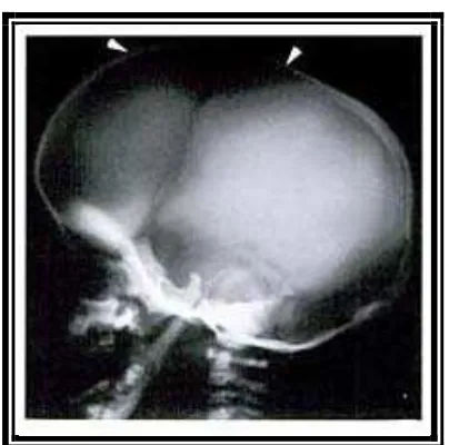 Gambar 11. Roentgen foto sefalometri pediatric imaging.Medical Publishers Inc,2005 :619)penderita Kleidokranial displasia  memperlihatkan radiolusen pada bagian sutura.( Babyn PS