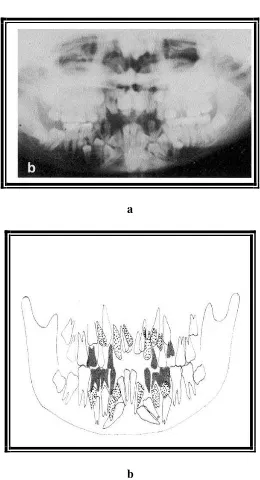 Gambar 12. X-ray panoramik (a) dan tracing (b) pada penderita Kleidokranial displasia memperlihatkan adanya supernumerary teeth; gigi desidui (hitam), supernumerary teeth (abu-abu), gigi permanen (putih) (López BSG, Solalinde CO, Ito TK, Carillo EL, Soladi