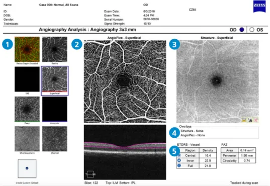Gambar 2.5 Analisis Densitas Vaskular Pleksus Kapiler Superfisial Makula               Penampang 3x3 mm Pada Pencitraan OCTA    