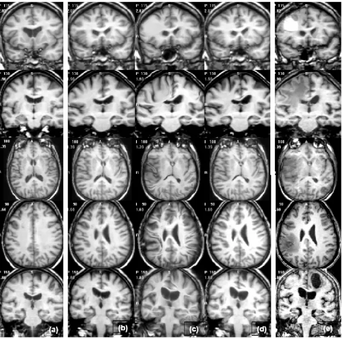 Figure I.1: Registration of source (atlas) and target (patient) MR images. Each row repre- repre-sents a different inter-subject registration set; source images in column (a) are transformed to patient images in column (e)