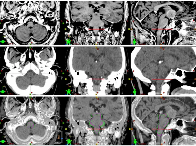 Figure I.2: Brainstem: medulla. MR imaging sections [top row], CT [middle row], and fused image with several expert (green) and the automatic (purple) segmentations [bottom row]