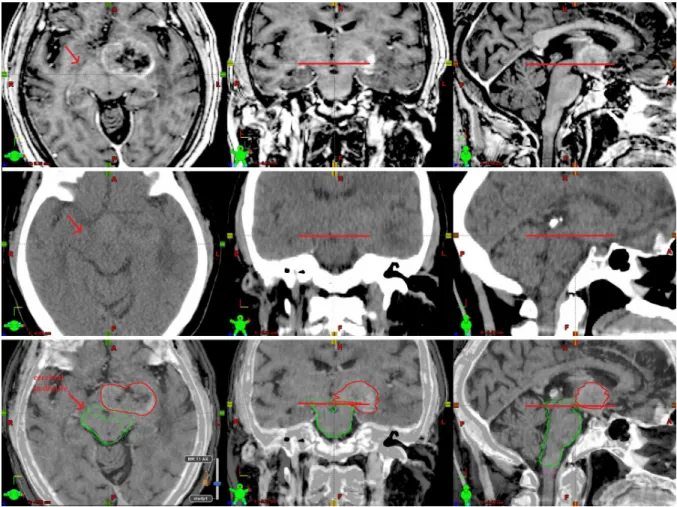 Figure I.4: Brainstem: midbrain. MR [top row], CT [middle row] and fusion [bottom row]