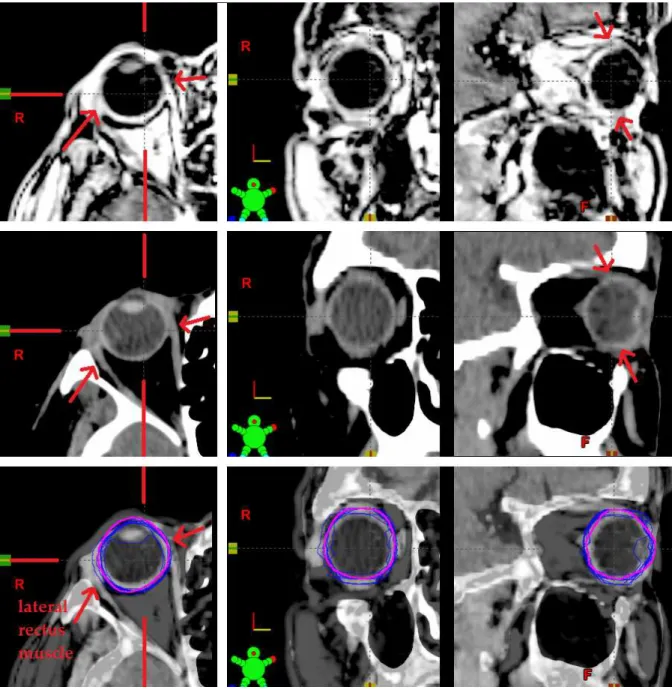 Figure I.5: Eye and recti muscles. MR [top row], CT [middle row] and fusion [bottom row]