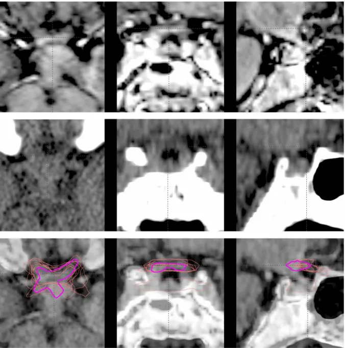 Figure I.7: Optic chiasm. The optic chiasm is shown in MR [top row], CT [middle row] and fused [bottom row] images