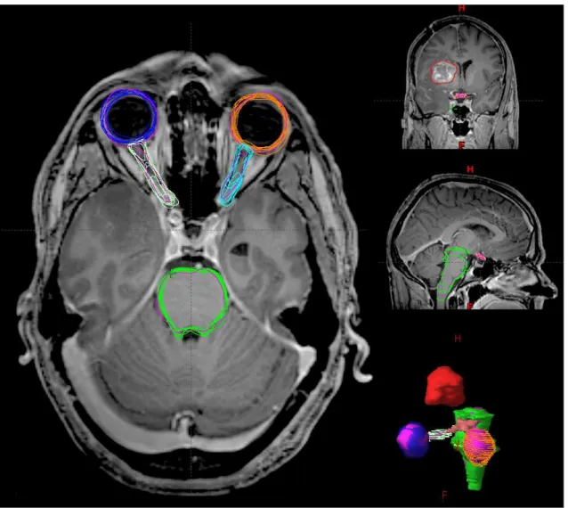 Figure II.2: A randomly chosen patient from the 20 cases used in this study. Eight physician raters segmented the brainstem, optic chiasm, eyes, and optic nerves using a fused CT/MR image set