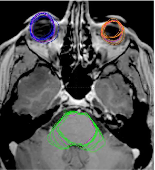 Figure II.3: Axial slice showing an area of high physician variability within the brainstem
