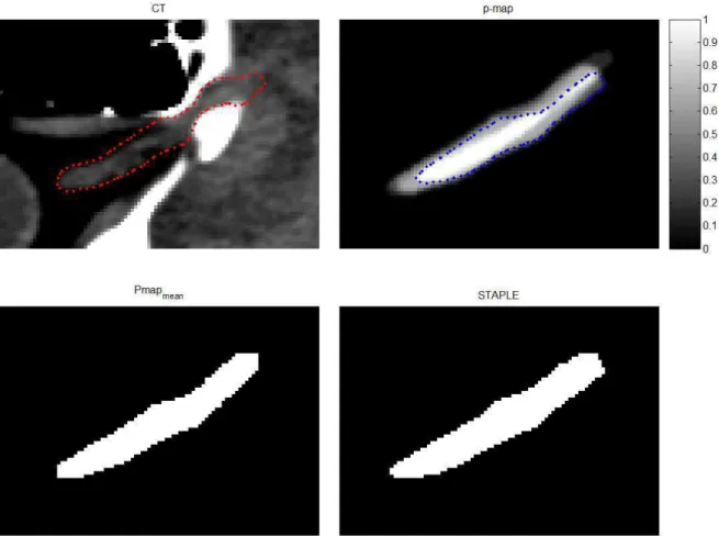 Figure III.1: Ground truth estimation. The upper left panel displays the area of an optic nerve for patient 12 on an axial CT slice