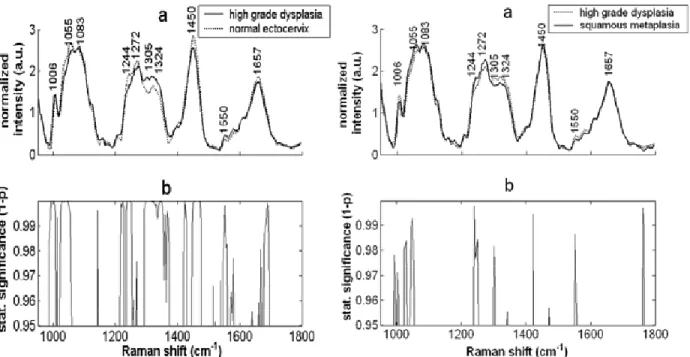 Figure  3.3: Spectra Comparison: High Grade  Dysplasia vs. Normal Ectocervix. 