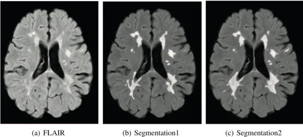 Figure 1.1: An example of manual segmentations from different human raters. The delin- delin-eations are overlaid with the FLAIR image