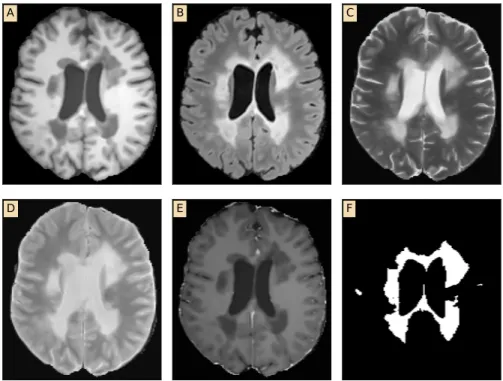 Figure 2.1 shows an example of different MRI sequences from the same subject (MIC- (MIC-CAI 2016)