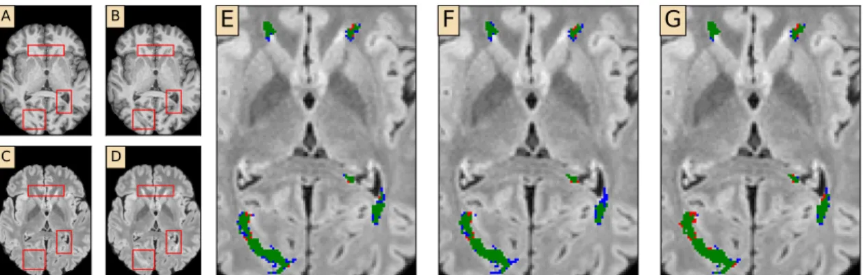 Figure 3.2: Qualitative results from the simulated in-house dataset. (A) Original T1-w image (B) Simulated T1-w image (C) Original FLAIR image (D) Simulated FLAIR image (E-G) Zoomed-in segmentation results with L 2 loss, Dice loss and focal loss, respectiv