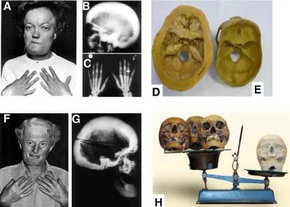 Figure 3.2. Genetic mutation of the sclerostin gene and regulating elements causes a severe  bone overgrowth phenotype