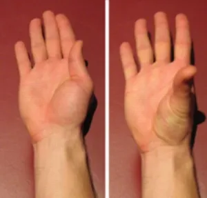 Figure 2 Thumb abduction to adduction (right hand) 