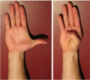 Figure 3 Thumb extension to flexion (right hand) 