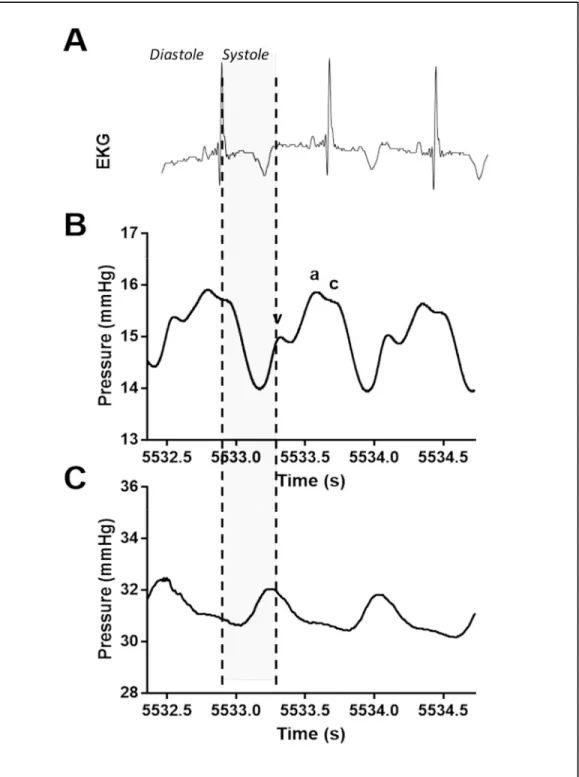 Figure 1 Comparison of central and peripheral venous waveforms. (A)  Electrocardiogram (EKG) time-synced with directly transduced (B) central venous  waveform obtained from the superior vena cava and (C) peripheral venous waveform  obtained from the extrem