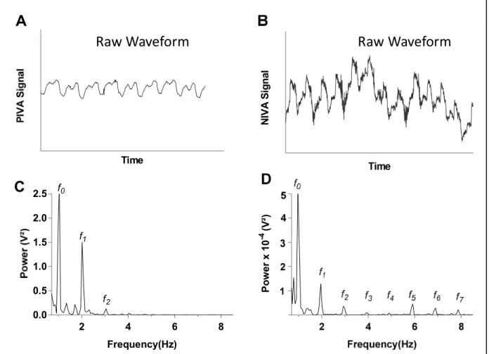 Figure 3 Representative venous waveform signals of a patient with volume overload (PCWP=28)