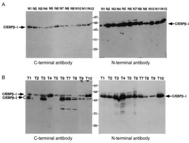 Figure  5.  C/EBPbeta  isoform  expression  in  mammary  samples.  Whole cell  extracts  were  prepared  from  A,  normal  breast  tissue  from  reductive  mammoplasty or B, breast tumors obtained from the Tissue Procurement Core at  Vanderbilt  University