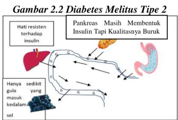 Gambar 2.2 Diabetes Melitus Tipe 2 