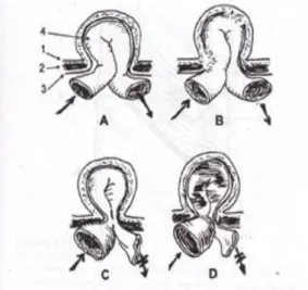Gambar 2. Klasifikasi Hernia Menurut Sifat Keterangan  gambar  2.:  (1)  Kulit  dan  jaringan  subkutan    (2)  Lapisan  otot  (3)  Jaringan  praperitoneal  (4)  Kantong  hernia  dengan  usus