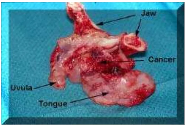 Gambar 2. Tumor hasil dari pengangkatan dengan bedah ablative.  ( K Deepak. Oral cancer