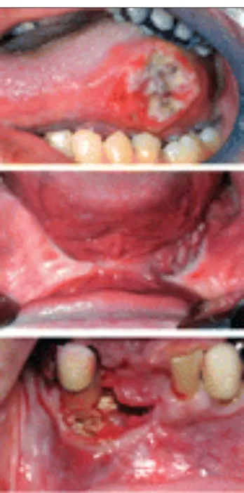 Gambar 3. Kanker dalam rongga mulut indikasi bedah www.mayoclinicproceedings.comablative
