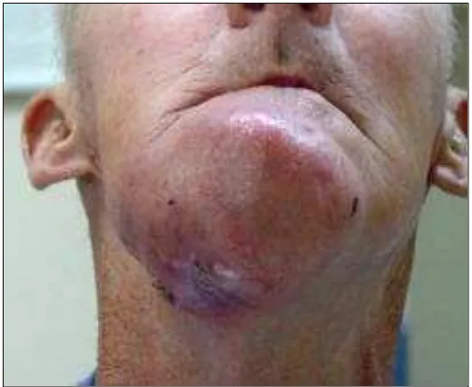 Gambar 4. Tumor pada dagu atau mandibula yang memiliki ukuran yang besar. (National cancer institute