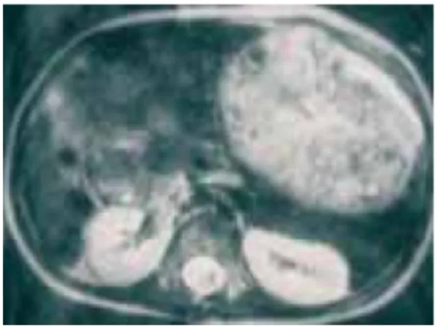 Gambar 1. CT scan: Massa dengan ukuran  sangat besar mulai dari cavum pelvis kanan   sampai  epigastrium,  ada  kistik  dan  kalsifikasi