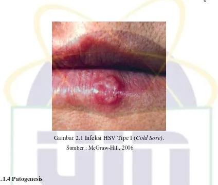 Gambar 2.1 Infeksi HSV Tipe I (Cold Sore). 