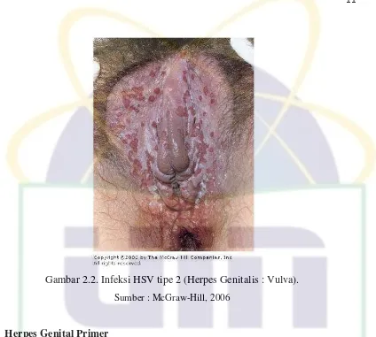 Gambar 2.2. Infeksi HSV tipe 2 (Herpes Genitalis : Vulva). 