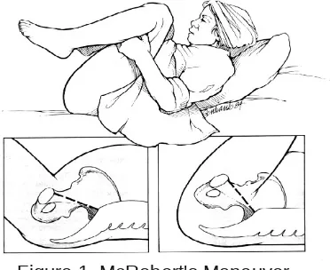 Figure 1. McRobert's Maneuver