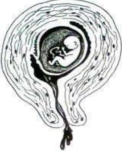 Gambar 9.1. Abortus Imminens 