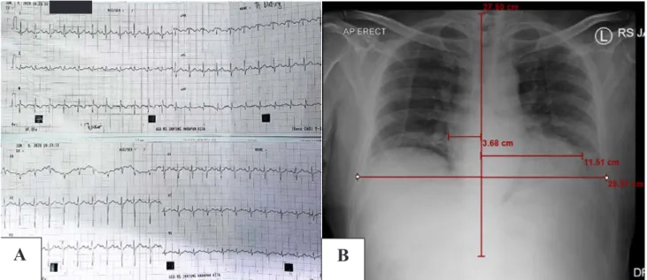 Figure 1. A. ECG of Mr. DT at admission; B. chest X-ray of Mr. DT at admission.