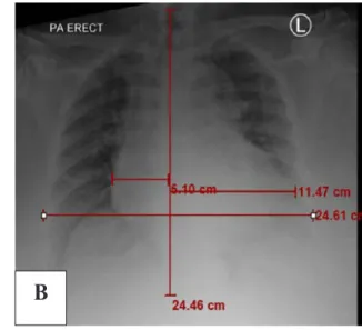 Figure 2. A. ECG of Mrs. S at admission; B. chest X-ray of Mrs. S at admission.