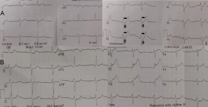 Figure 1. Electrocardiogram (ECG) in Emergency Department. (A) Initial ECG showed sinus rhythm with j-point depression  upsloping pattern (non-ﬁll-arrow) followed by prominent T wave in precordial leads (black-ﬁll-arrow), slight ST-segment  elevation in aV