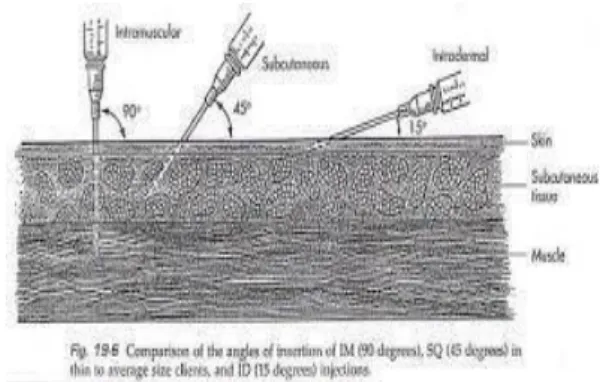 Gambar 2. Sudut Kemiringan Penusukan Venna Puncture (10)