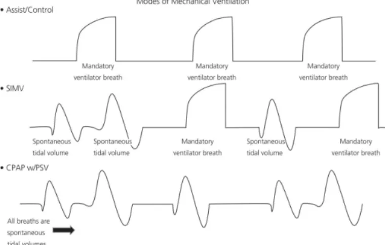 Figure 3.6 CPAP, PS, and AC patterns.