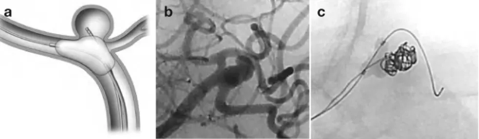     Type 3: Figure 3. Broad-Necked Aneurysm, Balloon Placed Parallel  to Neck via Circle of Willis  (Fig