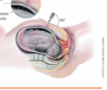 Figure 2-3  Amniocentesis: 15 to 20 mL of amniotic fluid is  withdrawn for study.