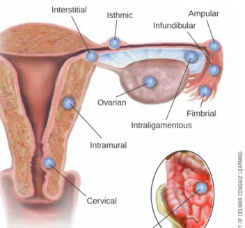 Figure 2-9 illustrates other possible sites of implantation in an  ectopic pregnancy.