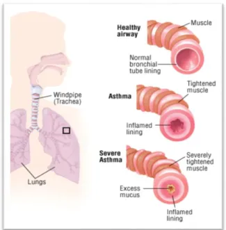 Gambar 2.4. Tanda Tiga Serangkai Asthma:  
