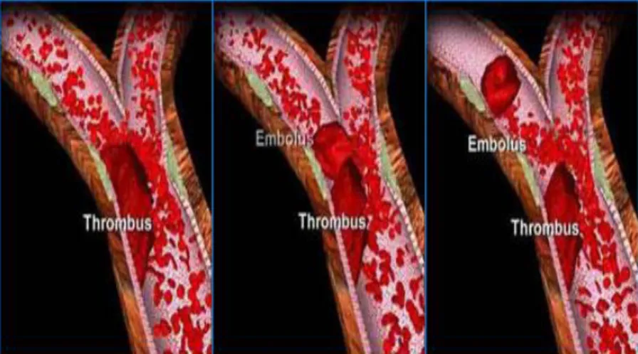 Gambar 2.7 Trombosis dan Emboli Serebral 