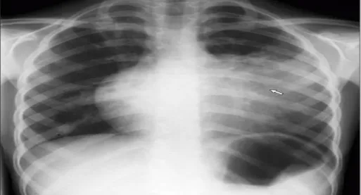 Gambar 1. 3 Hasil CT-Scan dengan TB Paru   (Grard & Bryan, 2019) 