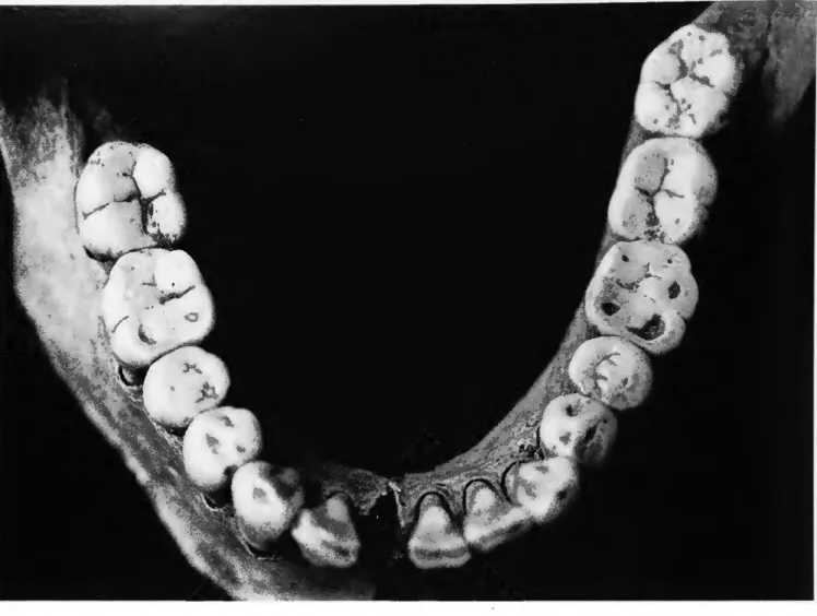 FIGURE 6.—Occlusal surfaces of mandibular teeth, P-l, Cranium 2. 