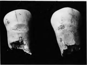 FIGURE 7.—Interproximal grooves on mandibular right first premolar (distal  surface) and second premolar (mesial surface), P-l, Level 3