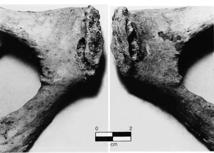FIGURE  8.—Pubic bones of 45- to 50-year-old female, P-3, E-5, showing deep pitting. 