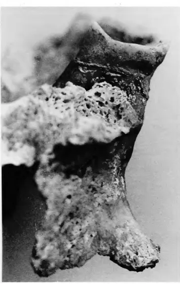 FIGURE 10.—Interproximal groove on the distal buccal surface of the maxillary  first molar illustrated in Figure 9, P-3, E-5