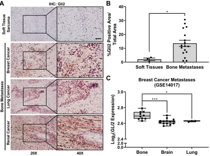 Fig.  3.1.  Gli2  is  overexpressed in  patient  bone-metastatic  tumors.  (A)  Representative images  of  Gli2 IHC  for  patient soft tissue sarcomas  (n = 3) and bone-metastatic tumors (n = 17) from different primary origins